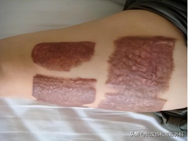 棉簽冰塊夾子擴張器是干嘛用的(皮膚擴張器的作用)