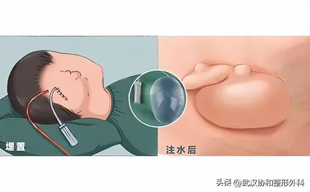 棉簽冰塊夾子擴張器是干嘛用的(皮膚擴張器的作用)