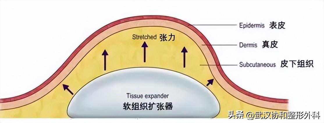 棉簽冰塊夾子擴張器是干嘛用的(皮膚擴張器的作用)