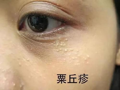 臉上長了好多小顆粒但又不像痘痘(教你怎樣去掉)